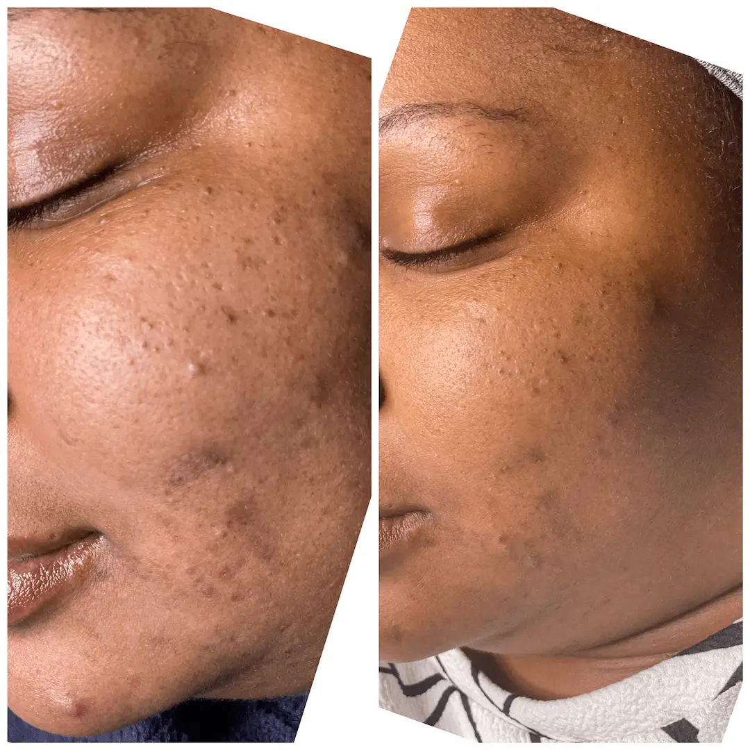 Before and after comparison of BioRePeel results showing reduction in active acne and hyperpigmentation at Two Chicks Aesthetics in Port Jefferson, NY.