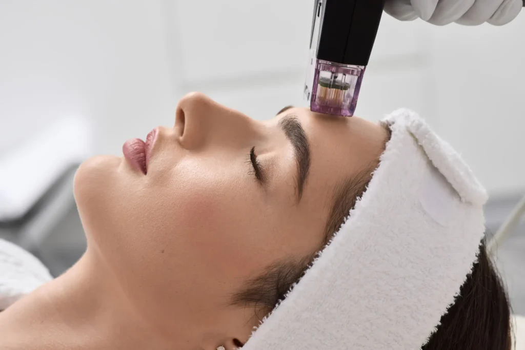 Professional Microneedling treatment designed to reduce fine lines, acne scarring, and signs of aging on the face and perform microneedling scar treatment.
