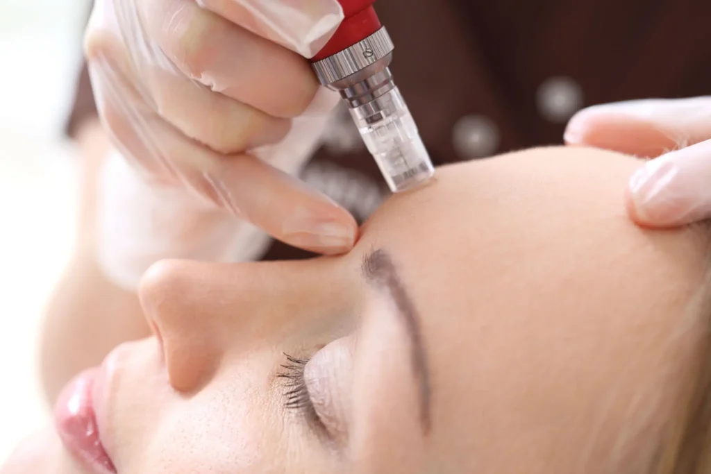 Close-up of a provider using a microneedling pen on a client's forehead to treat fine lines and stimulate collagen at Two Chicks Aesthetics.